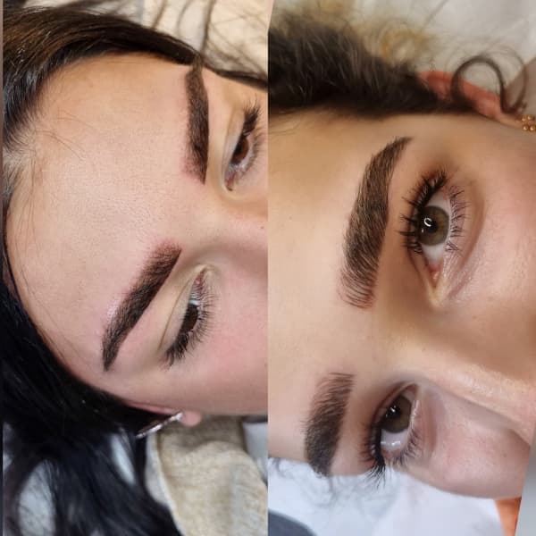 Brow Lift